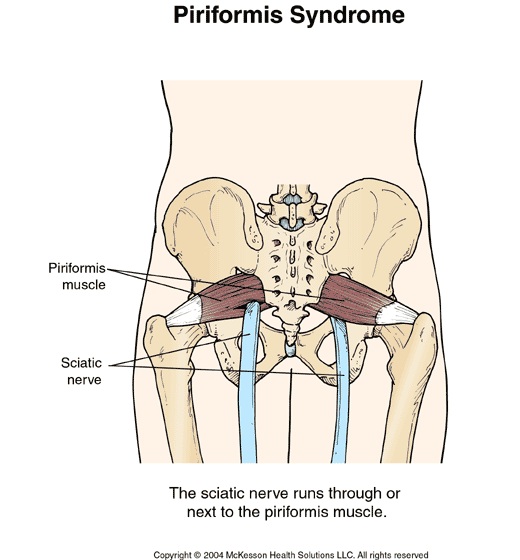 What is Piriformis Syndrome?